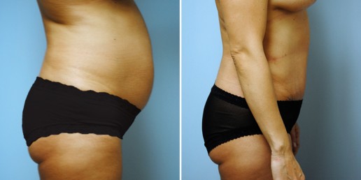 abdominoplasty-01c-stern