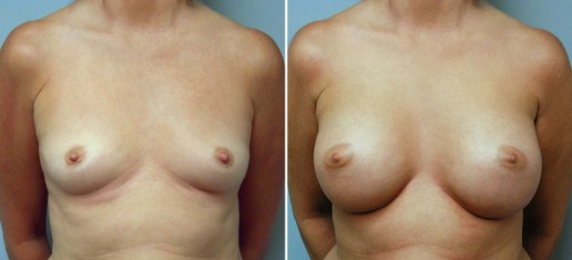 breast-augmentation-01a-stern