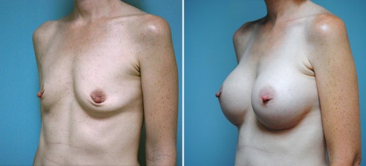 breast-augmentation-02b-stern