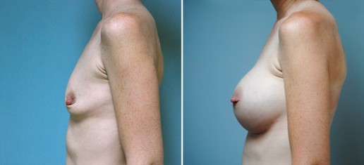 breast-augmentation-02c-stern