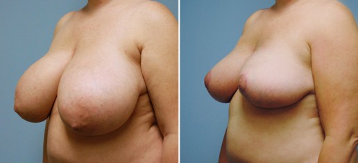 breast-reduction-01b-stern