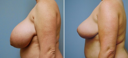 breast-reduction-01c-stern