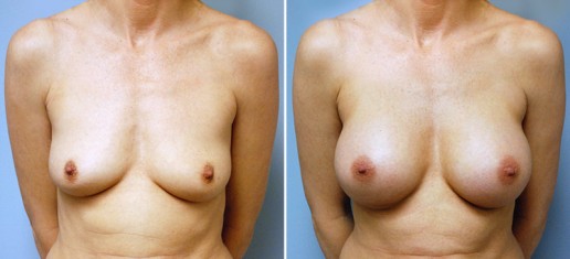 breast-augmentation-03a-stern