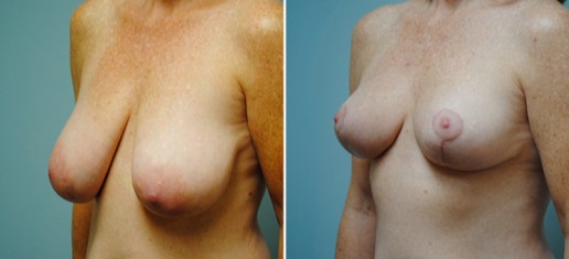 Asheville Breast Reduction 4