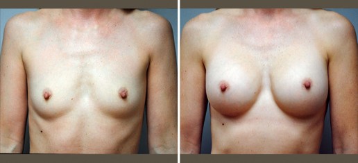 breast-augmentation-04a-new