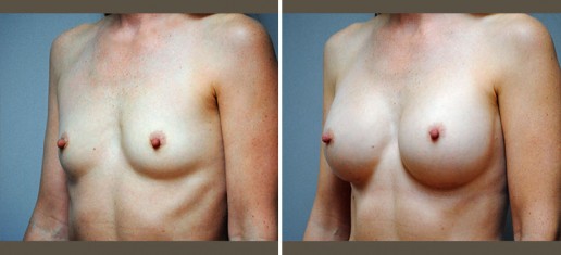 breast-augmentation-04b-new