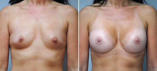 breast-augmentation-05a-stern