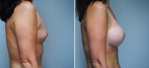 breast-augmentation-05b-stern