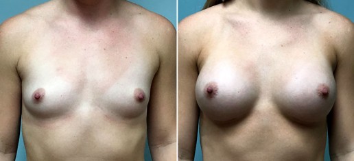 breast-augmentation-2360a-stern
