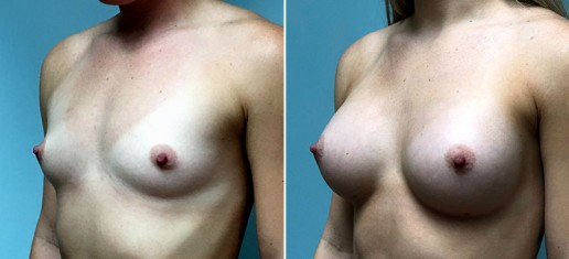 breast-augmentation-2360b-stern