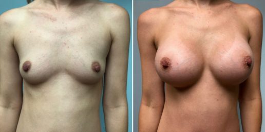 Breast Augmentation 6a