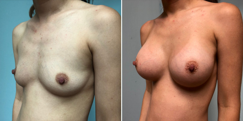 Breast Augmentation 6b