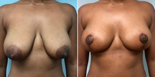 Mastopexy 1a