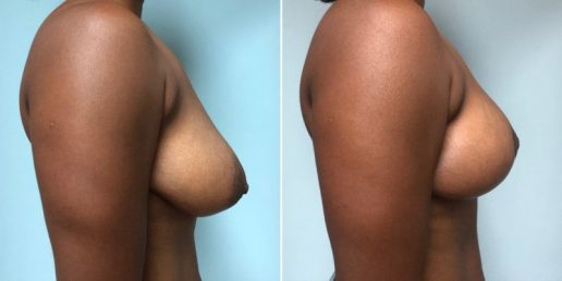 Mastopexy 1b