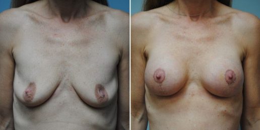 Mastopexy 2a