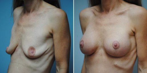 Mastopexy 2b