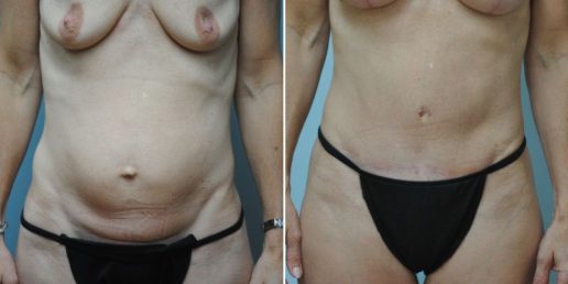 abdominoplasty 11a