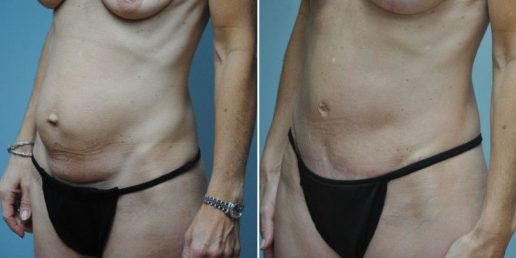 abdominoplasty 11b