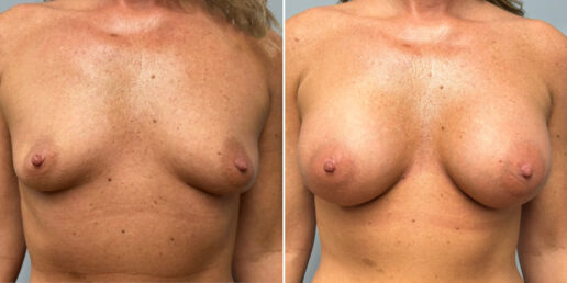 Breast-Augmentation-8a