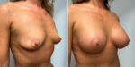 Breast Augmentation