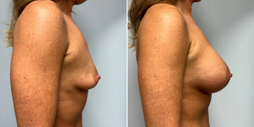 Breast-Augmentation-8c