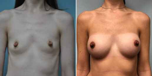 Breast-Augmentation-9a