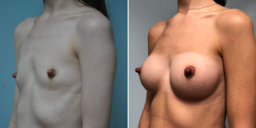 Breast-Augmentation-9b