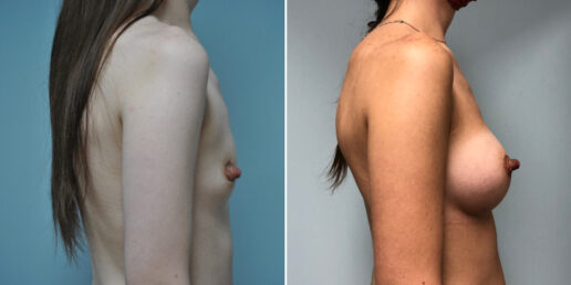 Breast-Augmentation-9c