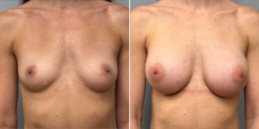 Breast-Augmentation-10a3