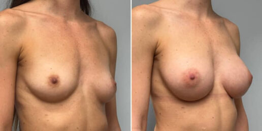 Breast-Augmentation-10b3